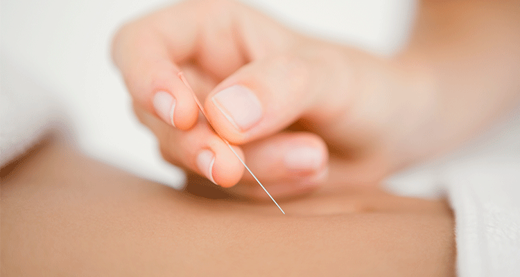 Close-up of a practitioner placing a fine acupuncture needle