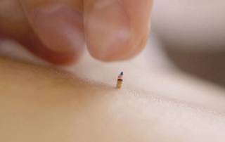 A small cone of moxa placed on skin