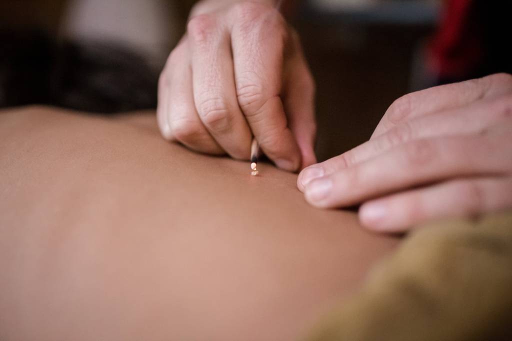 Hands placing an acupuncture needle during treatment