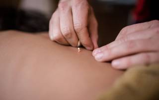 Hands placing an acupuncture needle during treatment